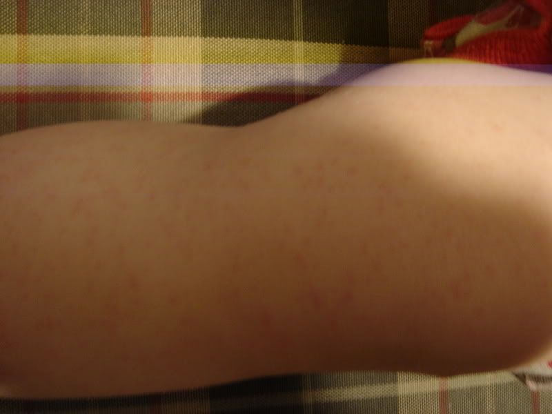 meldinger herpes blemmer meldinger herpes blemmer
