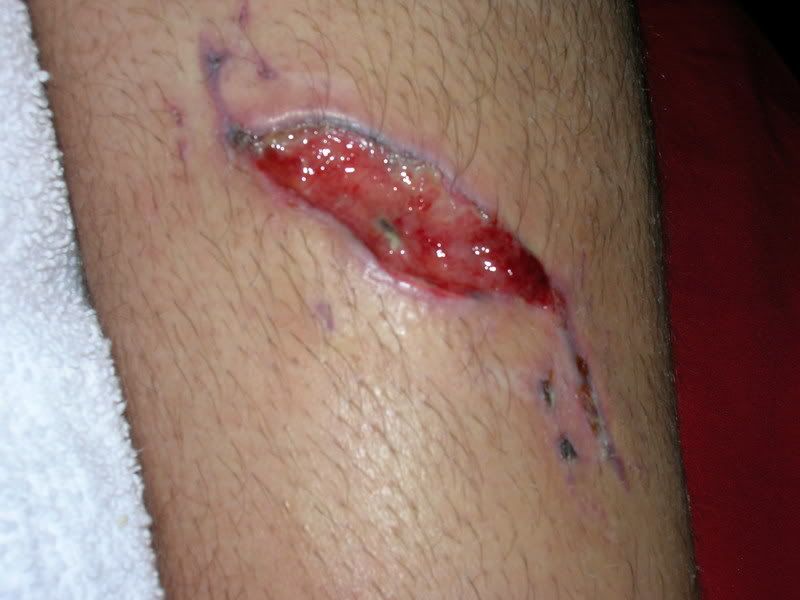 http://i29.photobucket.com/albums/c269/whalen7840/My%20Accident/DSCN1414.jpg