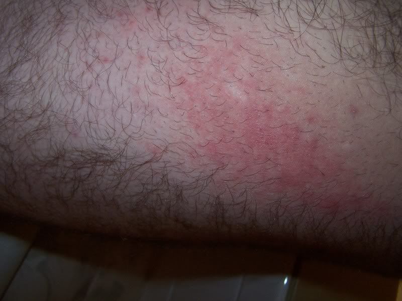 heat rash. heat rash on baby skin. rash