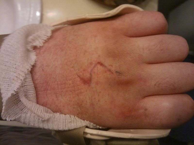 Hand Tendon Surgery