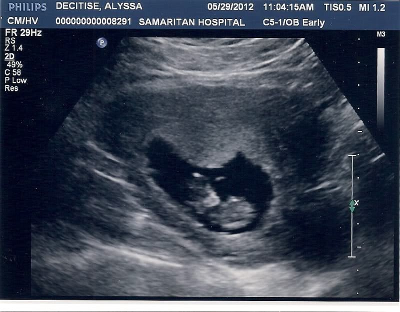 Pregnancy Issues: I had my dating ultrasound today!